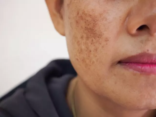 Melasma en el embarazo- Cuida tu salud hoy